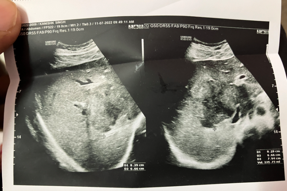 #1 Liver Abscess symptoms, best diet, tests & Symptoms 5 Liver Abscess Ultrasound Image